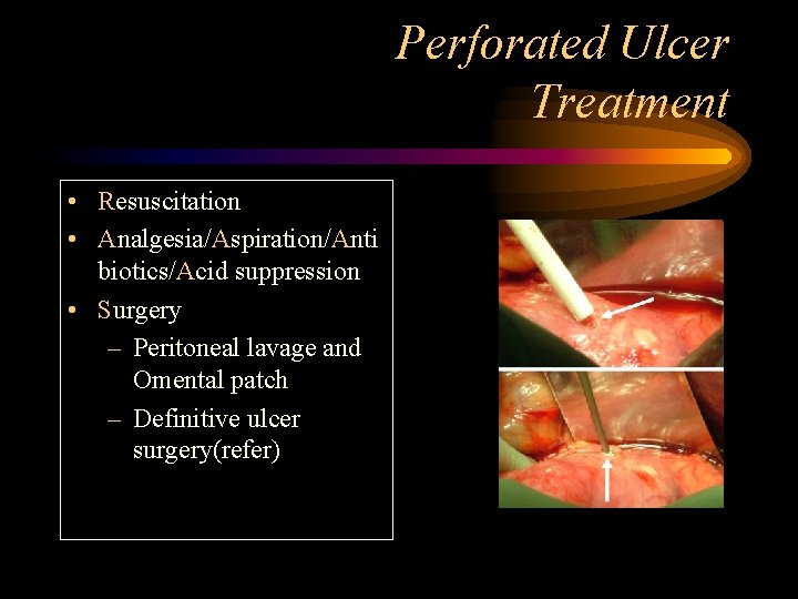 Perforated Ulcer Treatment • Resuscitation • Analgesia/Aspiration/Anti biotics/Acid suppression • Surgery – Peritoneal lavage