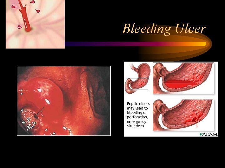 Bleeding Ulcer 