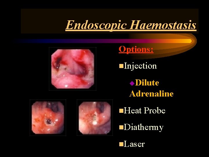 Endoscopic Haemostasis Options: n. Injection Dilute Adrenaline u n. Heat Probe n. Diathermy n.