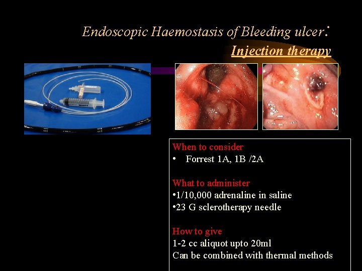 Endoscopic Haemostasis of Bleeding ulcer: Injection therapy When to consider • Forrest 1 A,