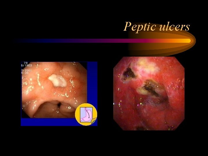 Peptic ulcers 