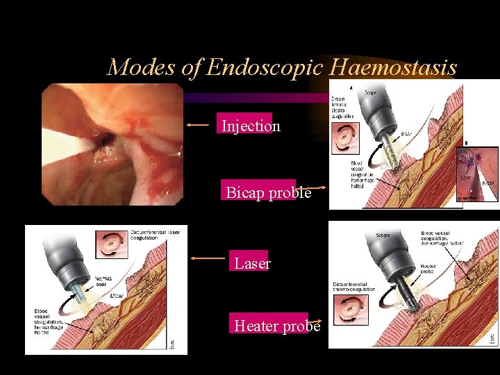 Modes of Endoscopic Haemostasis Injection Bicap proble Laser Heater probe 
