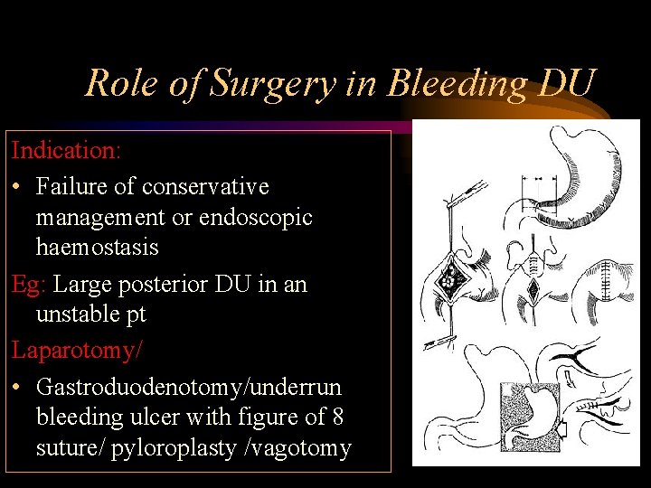 Role of Surgery in Bleeding DU Indication: • Failure of conservative management or endoscopic