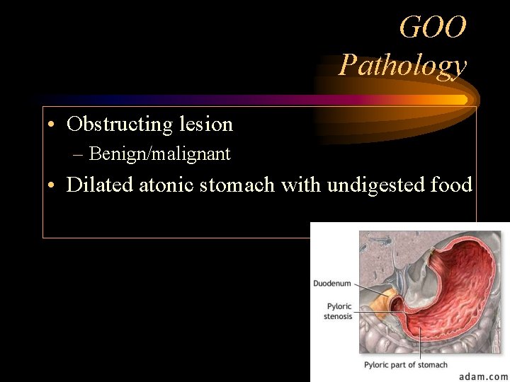 GOO Pathology • Obstructing lesion – Benign/malignant • Dilated atonic stomach with undigested food