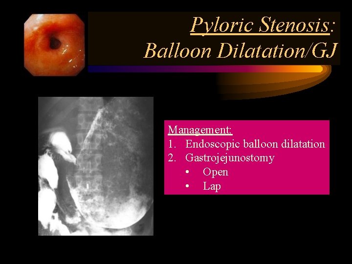 Pyloric Stenosis: Balloon Dilatation/GJ Management: 1. Endoscopic balloon dilatation 2. Gastrojejunostomy • Open •