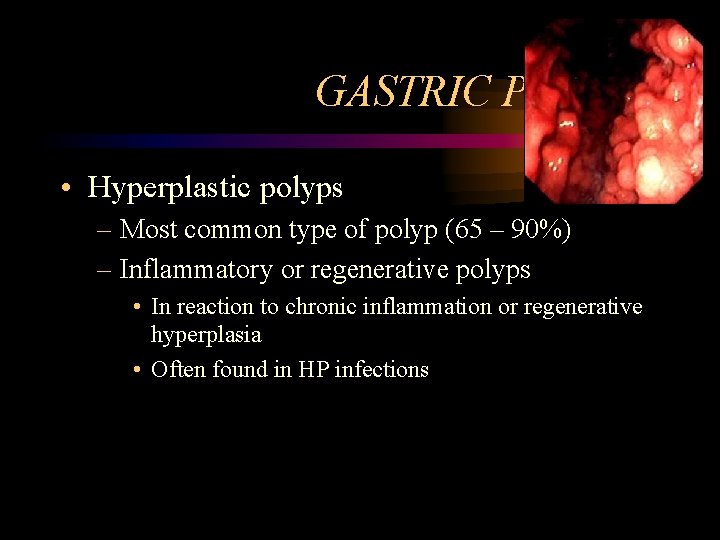 GASTRIC POLYPS • Hyperplastic polyps – Most common type of polyp (65 – 90%)
