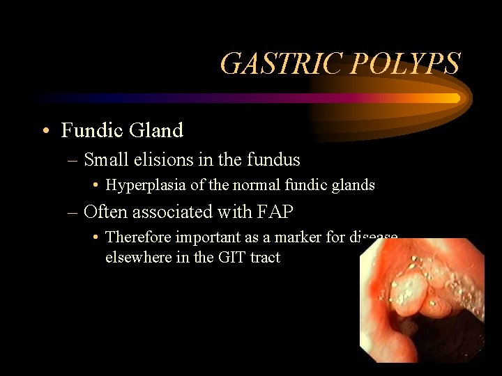 GASTRIC POLYPS • Fundic Gland – Small elisions in the fundus • Hyperplasia of