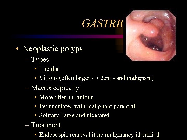 GASTRIC POLYPS • Neoplastic polyps – Types • Tubular • Villous (often larger -