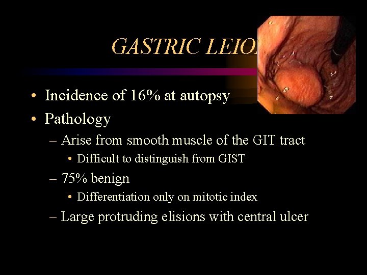 GASTRIC LEIOMYOMA • Incidence of 16% at autopsy • Pathology – Arise from smooth