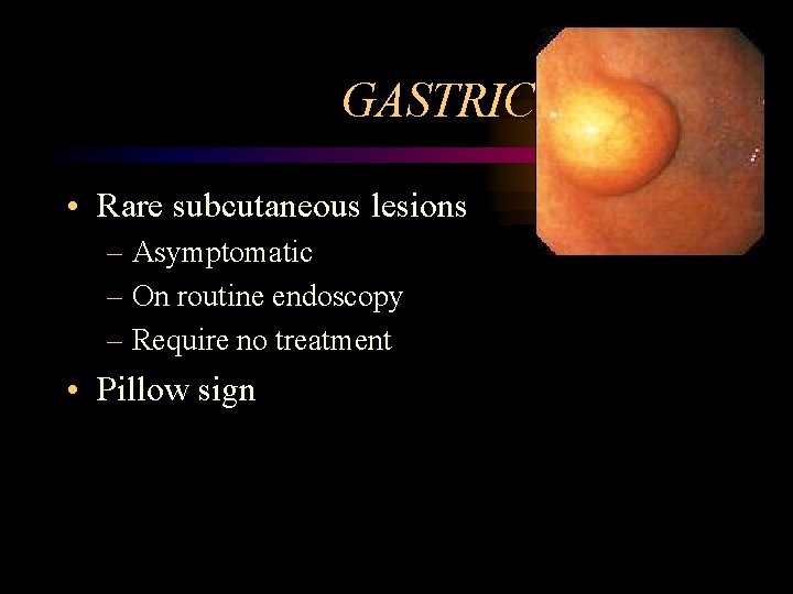 GASTRIC LIPOMA • Rare subcutaneous lesions – Asymptomatic – On routine endoscopy – Require