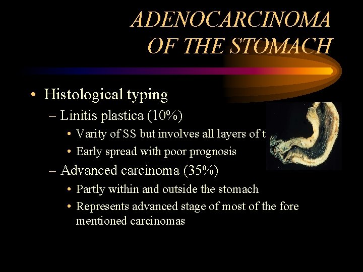 ADENOCARCINOMA OF THE STOMACH • Histological typing – Linitis plastica (10%) • Varity of
