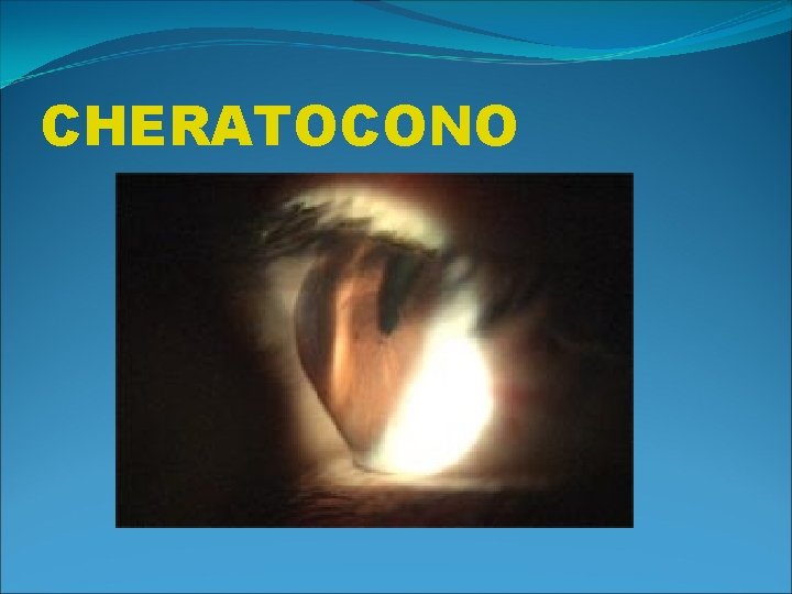 CHERATOCONO 