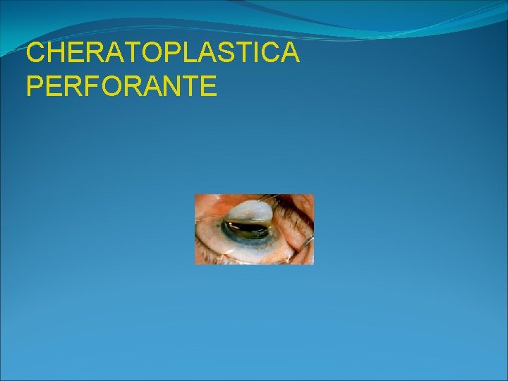 CHERATOPLASTICA PERFORANTE 