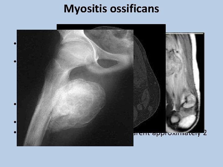 Myositis ossificans • Bone formation within muscle secondary to blunt trauma. • CF: –