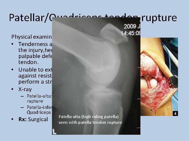 Patellar/Quadriceps tendon rupture Physical examination: • Tenderness at the site of the injury, hematoma,