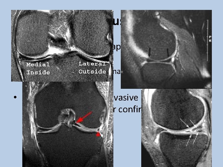 Meniscus tear • Standard knee radiographs should be obtained for evaluating for – Bone