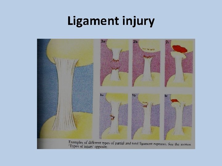Ligament injury 