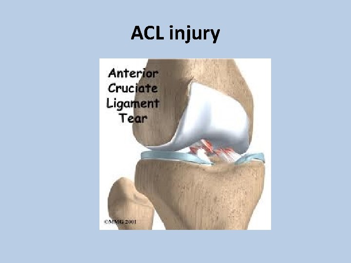 ACL injury 