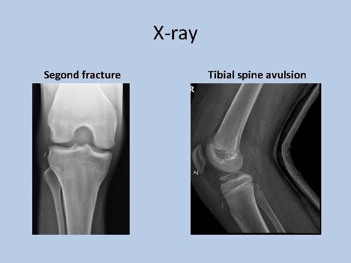 X-ray Segond fracture Tibial spine avulsion 