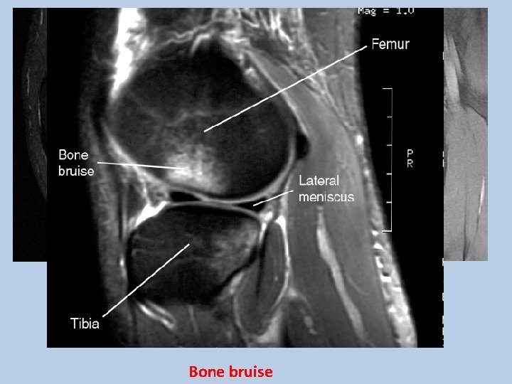 MRI Normal ACL Torn ACL Bone bruise 