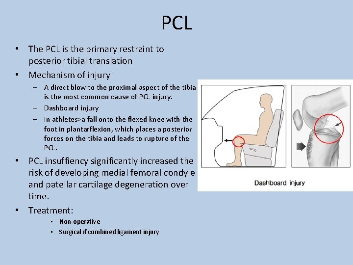 PCL • The PCL is the primary restraint to posterior tibial translation • Mechanism