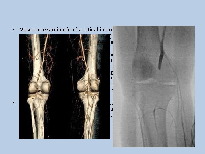  • Vascular examination is critical in an acutely dislocated knee. – Pulse and