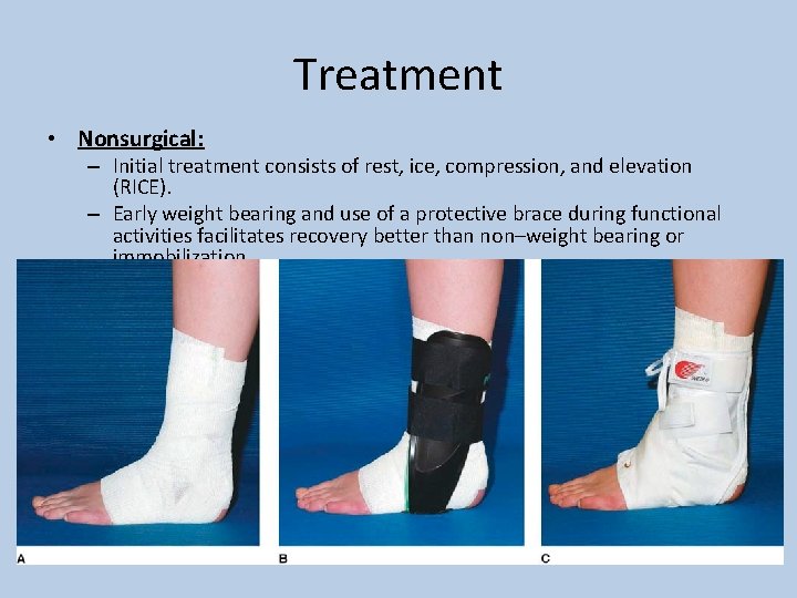 Treatment • Nonsurgical: – Initial treatment consists of rest, ice, compression, and elevation (RICE).