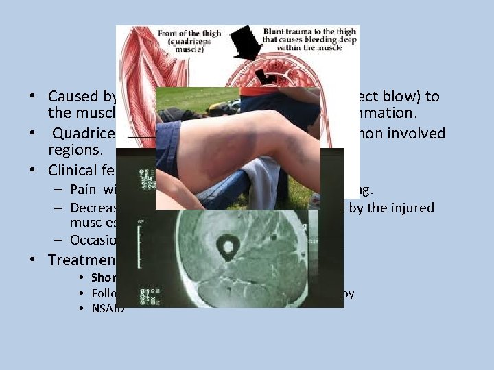 Muscle Contusion • Caused by a nonpenetrating blunt injury (direct blow) to the muscle