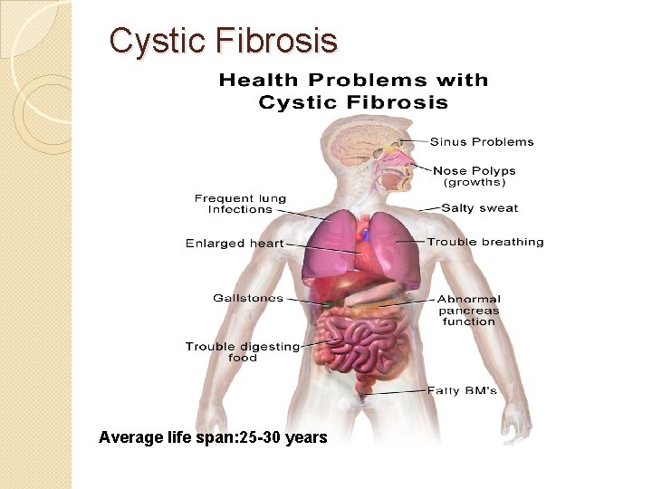 Cystic Fibrosis Average life span: 25 -30 years 