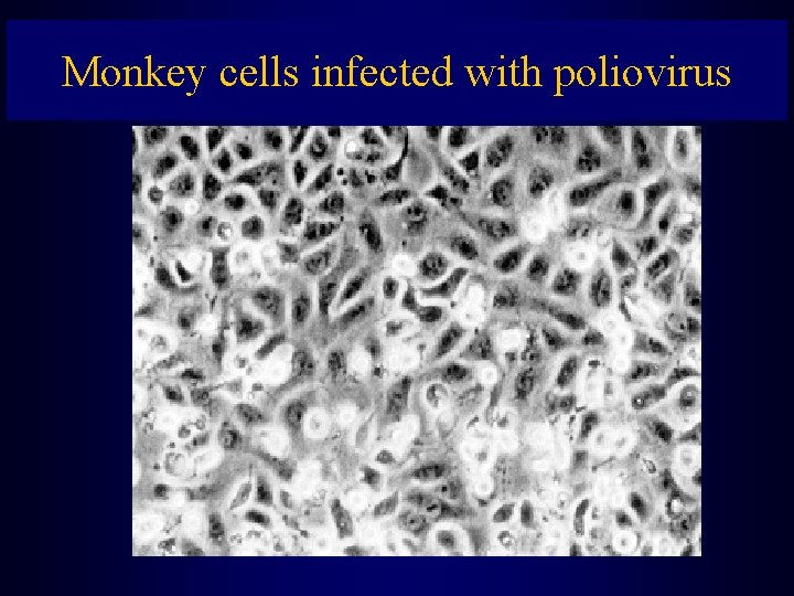 Monkey cells infected with poliovirus 
