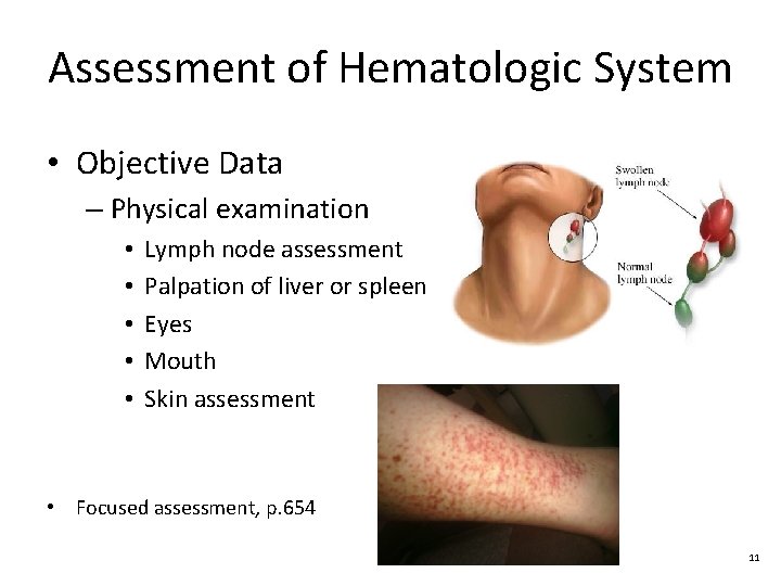 Assessment of Hematologic System • Objective Data – Physical examination • • • Lymph