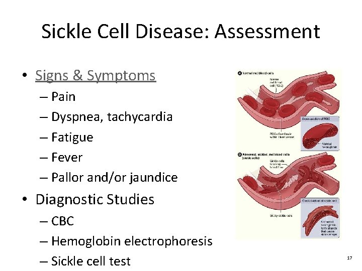 Sickle Cell Disease: Assessment • Signs & Symptoms – Pain – Dyspnea, tachycardia –