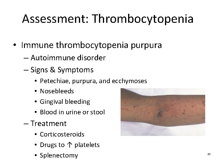 Assessment: Thrombocytopenia • Immune thrombocytopenia purpura – Autoimmune disorder – Signs & Symptoms •