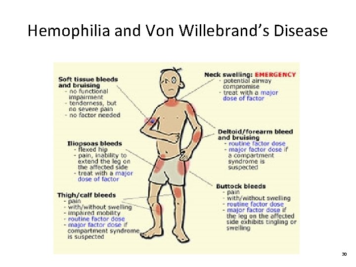 Hemophilia and Von Willebrand’s Disease 30 