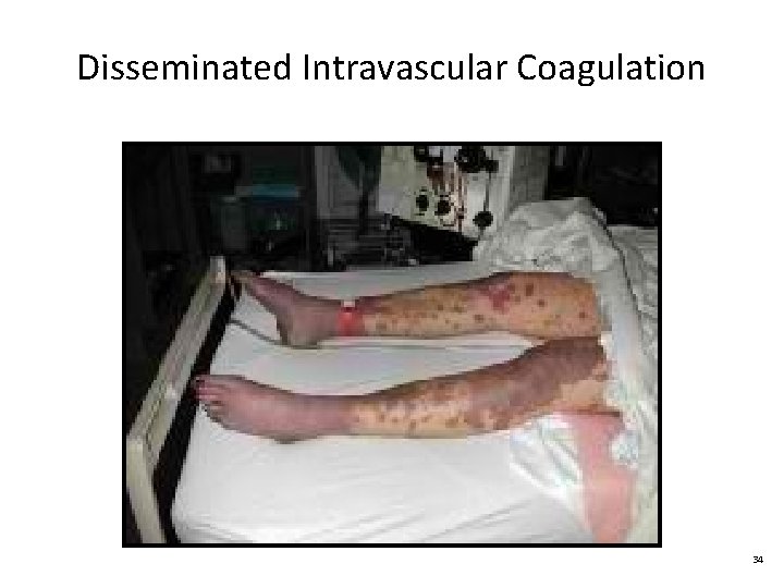 Disseminated Intravascular Coagulation 34 