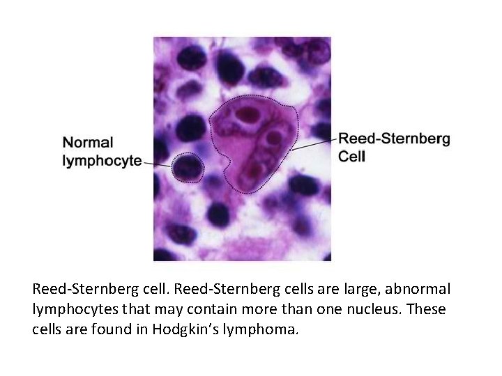 Reed-Sternberg cells are large, abnormal lymphocytes that may contain more than one nucleus. These