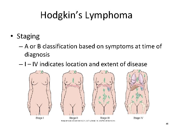 Hodgkin’s Lymphoma • Staging – A or B classification based on symptoms at time