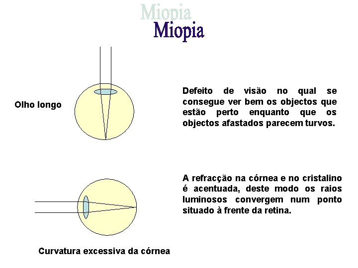 Olho longo Defeito de visão no qual se consegue ver bem os objectos que