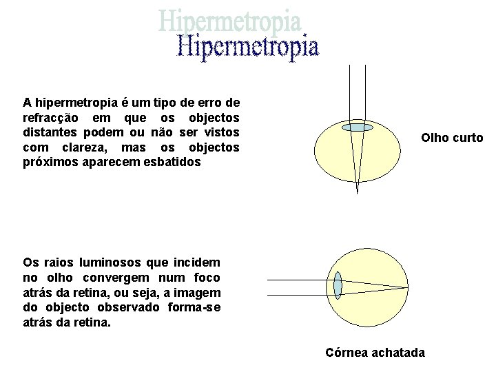 A hipermetropia é um tipo de erro de refracção em que os objectos distantes