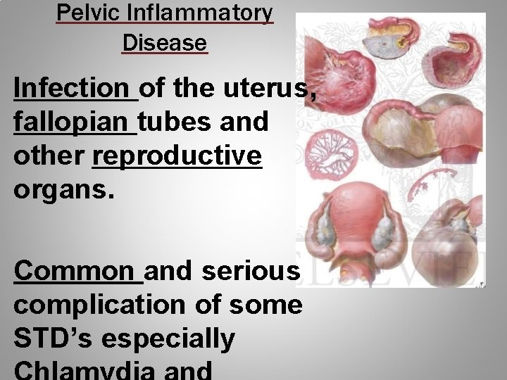 Pelvic Inflammatory Disease Infection of the uterus, fallopian tubes and other reproductive organs. Common