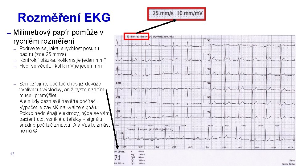 Rozměření EKG Milimetrový papír pomůže v rychlém rozměření Podívejte se, jaká je rychlost posunu