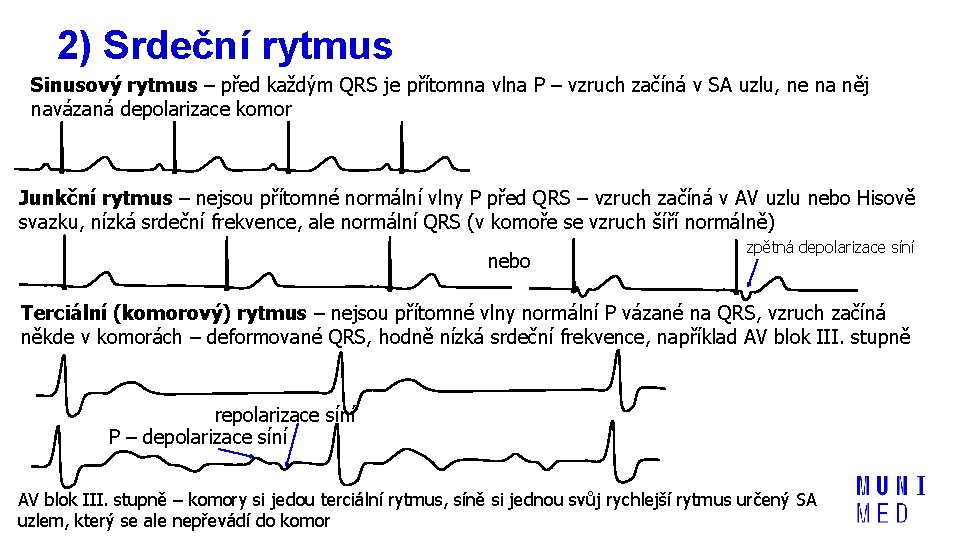 2) Srdeční rytmus Sinusový rytmus – před každým QRS je přítomna vlna P –