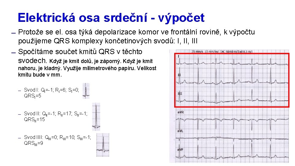 Elektrická osa srdeční - výpočet Protože se el. osa týká depolarizace komor ve frontální