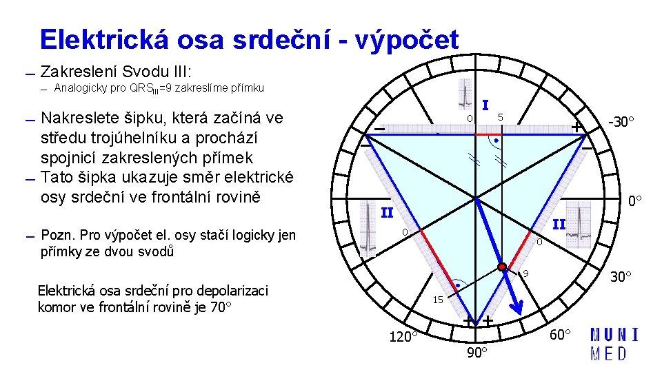 Elektrická osa srdeční - výpočet Zakreslení Svodu III: Analogicky pro QRSIII=9 zakreslíme přímku Nakreslete