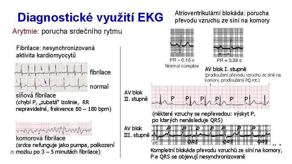 Atrioventrikulární blokáda: porucha převodu vzruchu ze síní na komory Diagnostické využití EKG Arytmie: porucha