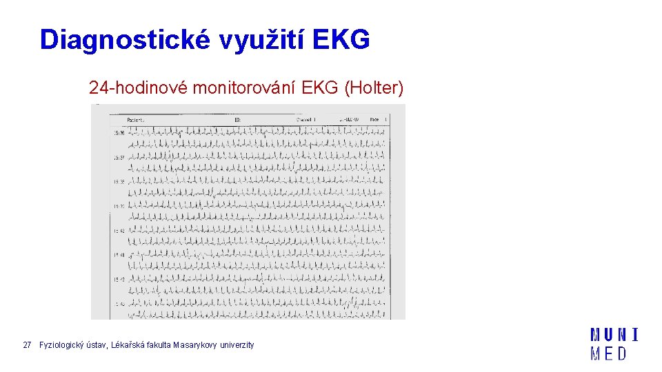 Diagnostické využití EKG 24 -hodinové monitorování EKG (Holter) 27 Fyziologický ústav, Lékařská fakulta Masarykovy