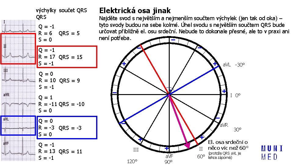 výchylky součet QRS Q = -1 R = 6 QRS = 5 S=0 Elektrická