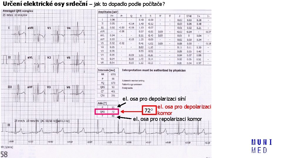 Určení elektrické osy srdeční – jak to dopadlo podle počítače? el. osa pro depolarizaci