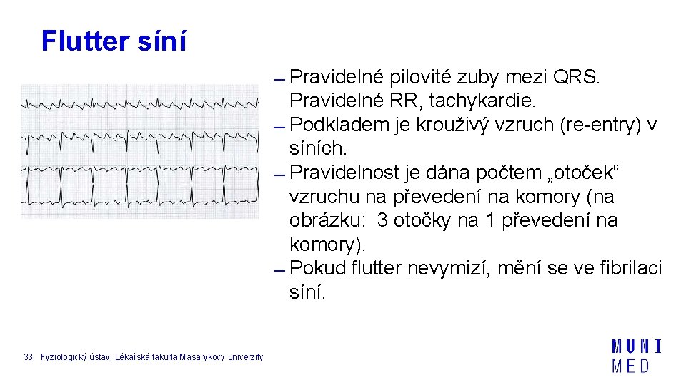 Flutter síní Pravidelné pilovité zuby mezi QRS. Pravidelné RR, tachykardie. Podkladem je krouživý vzruch