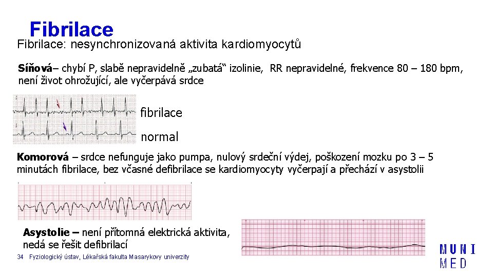 Fibrilace: nesynchronizovaná aktivita kardiomyocytů Síňová– chybí P, slabě nepravidelně „zubatá“ izolinie, RR nepravidelné, frekvence